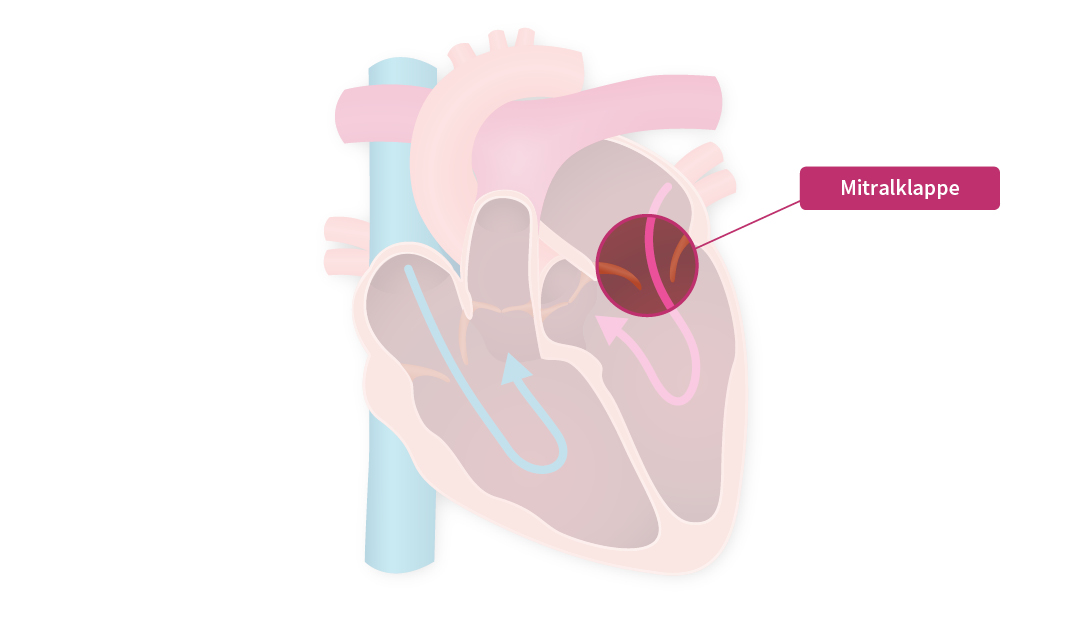 Eine Grafik die das innere des menschlichen Herzens mit den Herzklappen darstellt. Die Mitralklappe steht im Fokus.