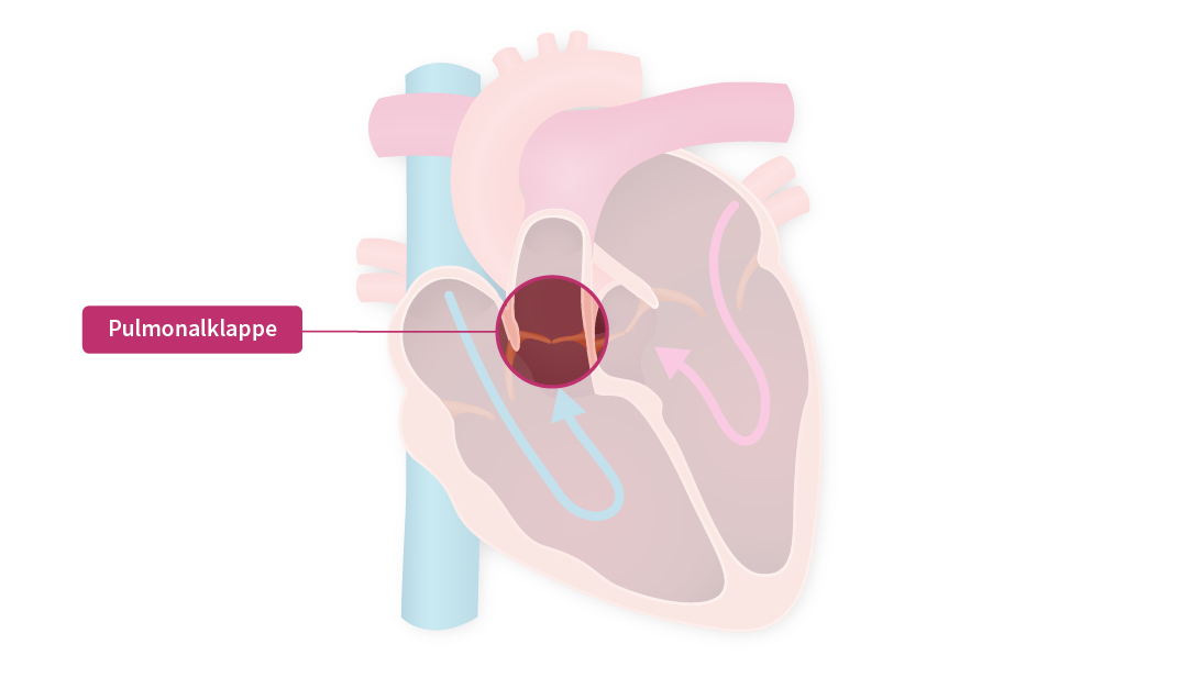Eine Grafik die das innere des menschlichen Herzens mit den Herzklappen darstellt. Die Pulmonalklappe steht im Fokus.